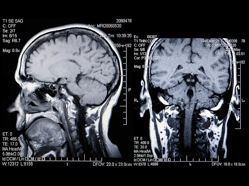 Гліоз головного мозку на МРТ