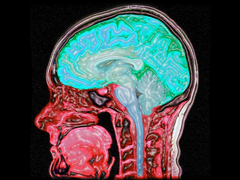 Гліоз головного мозку на МРТ